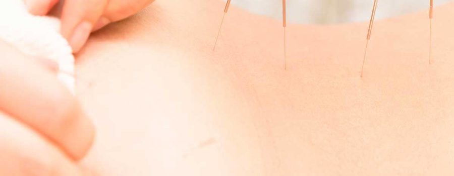 agulhas de acupuntura infeccao